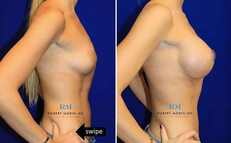 Female body, before and after Breast Implants treatment, right side view