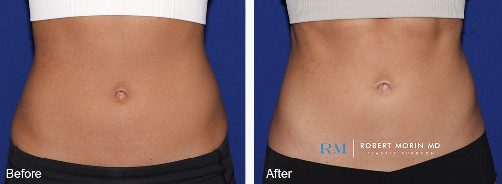 Woman's body, before and after EmSculpt treatment in Hackensack, New Jersey, front view, patient 1
