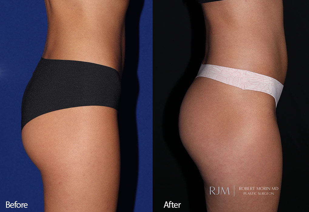 Woman's body, before and after EmSculpt treatment in Hackensack, New Jersey, side view, patient 1