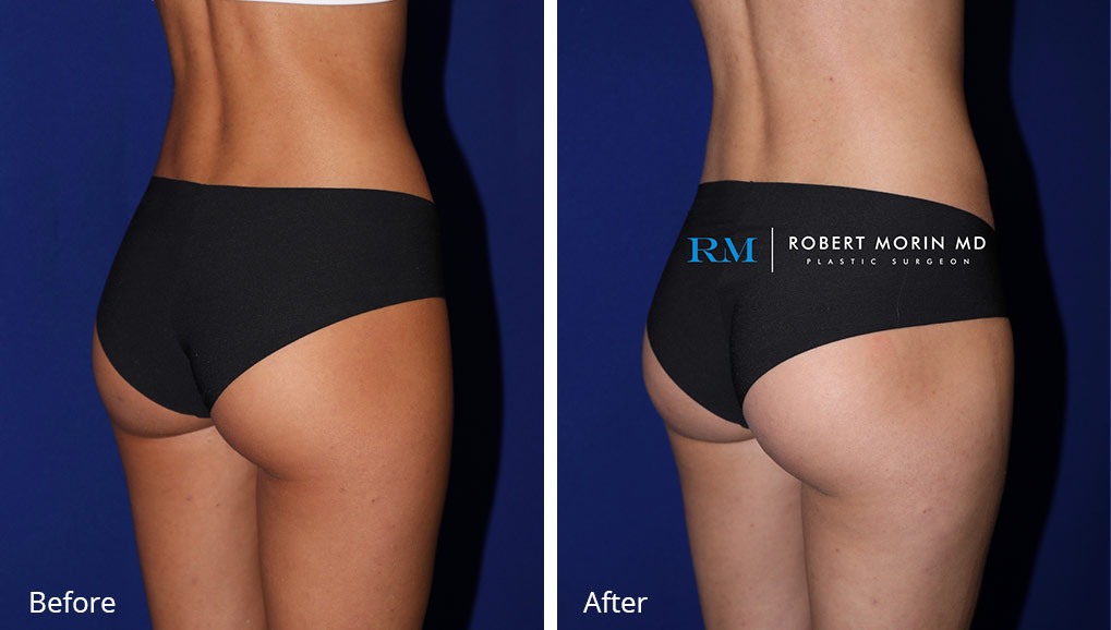 Woman's body, before and after EmSculpt treatment in Hackensack, New Jersey, back oblique view, patient 1