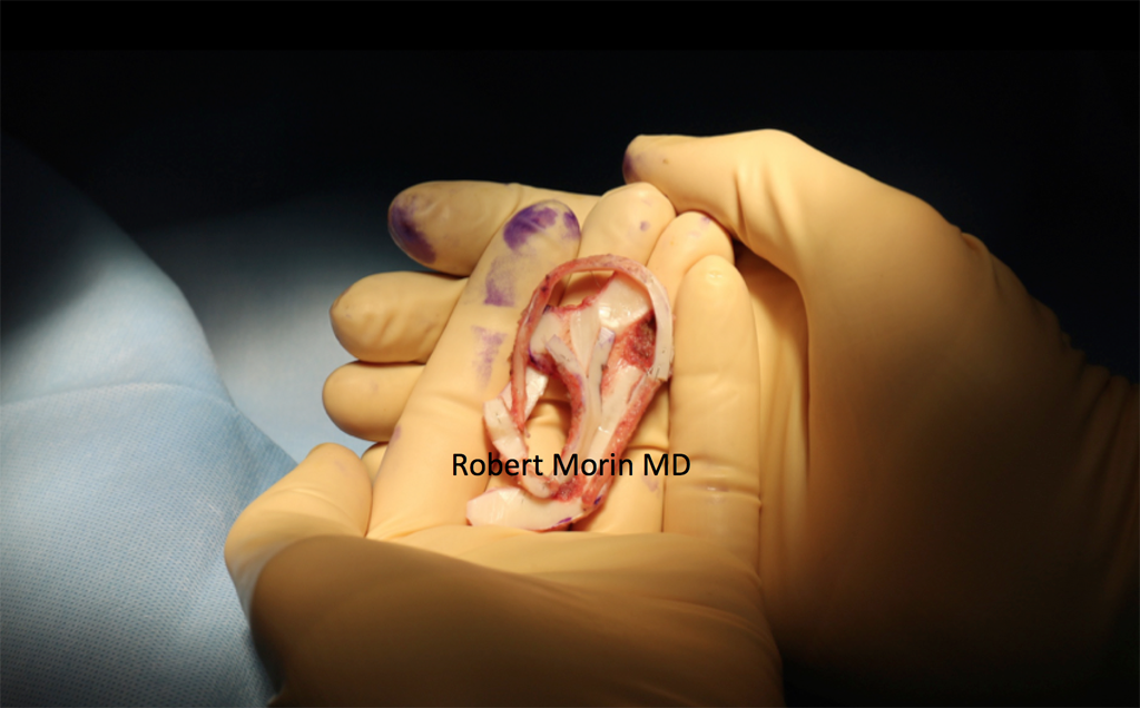 MICROTIA EAR RECONSTRUCTION - photo