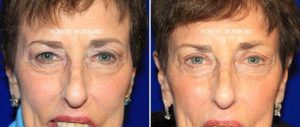  Female face, Eyelid Surgery (Blepharoplasty) Before & After Patient Miniature Set in New Jersey, front view, patient 2