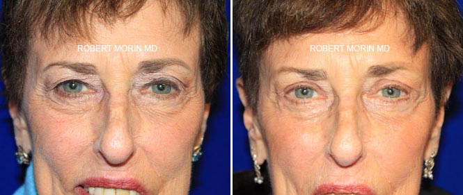  Female face, Eyelid Surgery (Blepharoplasty) Before & After Patient Miniature Set in New Jersey, front view, patient 2