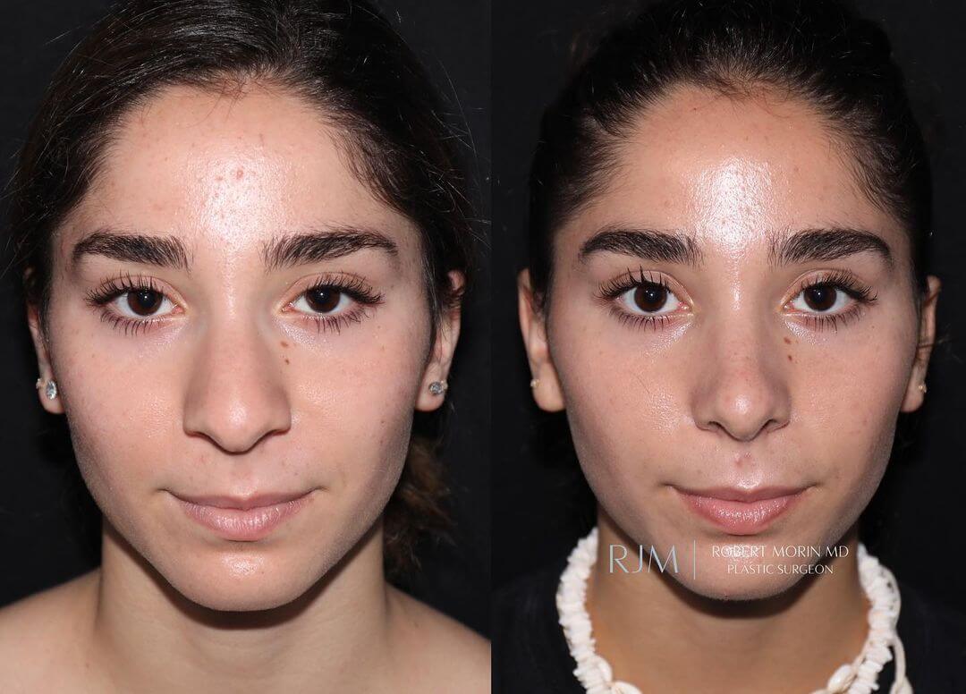 Female face, before and after Septoplasty treatment, front view