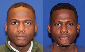  Male face, before and after rhinoplasty treatment, front view, patient 42