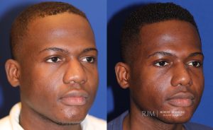 Male face, before and after rhinoplasty treatment, oblique view, patient 42