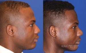  Male face, before and after rhinoplasty treatment, r-side view, patient 42