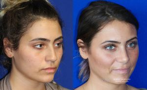  Female face, before and after rhinoplasty treatment, oblique view, patient 26