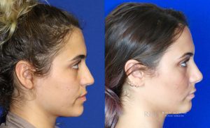  Female face, before and after rhinoplasty treatment, r-side view, patient 26