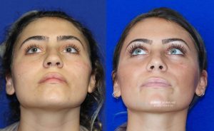  Female face, before and after rhinoplasty treatment, front view (thrown back) - patient 26