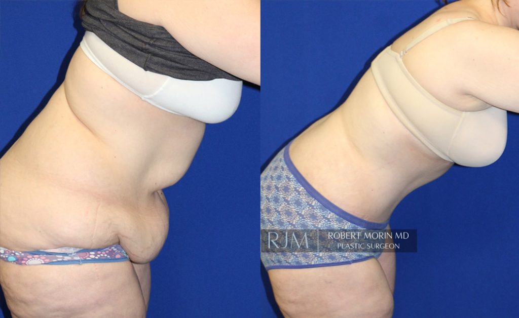  Woman's body, before and after abdominoplasty treatment in New Jersey, r-side view (bend over), patient 5