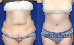  Woman's body, before and after abdominoplasty treatment, front view, patient 5