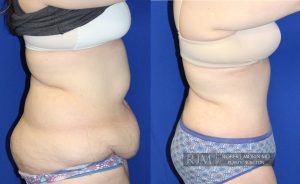  Woman's body, before and after abdominoplasty treatment, r-side view, patient 5