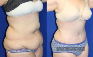  Woman's body, before and after abdominoplasty treatment, oblique view, patient 5