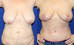  Woman's body, before and after abdominoplasty treatment in New Jersey, front view, patient 2