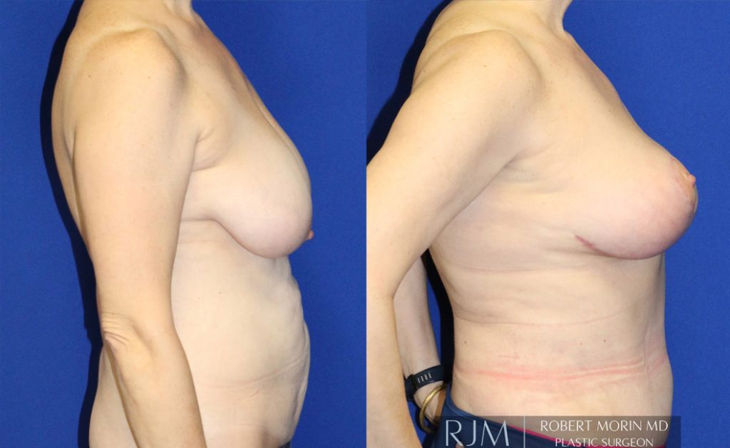  Woman's body, before and after abdominoplasty treatment in New Jersey, r-side view, patient 2