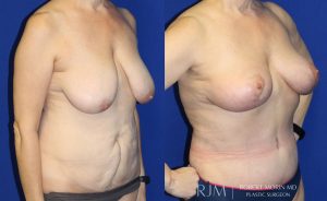  Woman's body, before and after abdominoplasty treatment, oblique view, patient 2