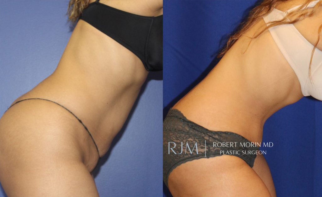  Woman's body, before and after abdominoplasty treatment in New Jersey, r-side view (bend over), patient 3