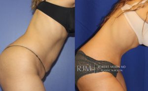  Woman's body, before and after abdominoplasty treatment, r-side view (bend over), patient 3