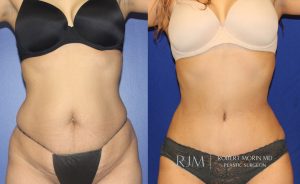  Woman's body, before and after abdominoplasty treatment, front view, patient 3