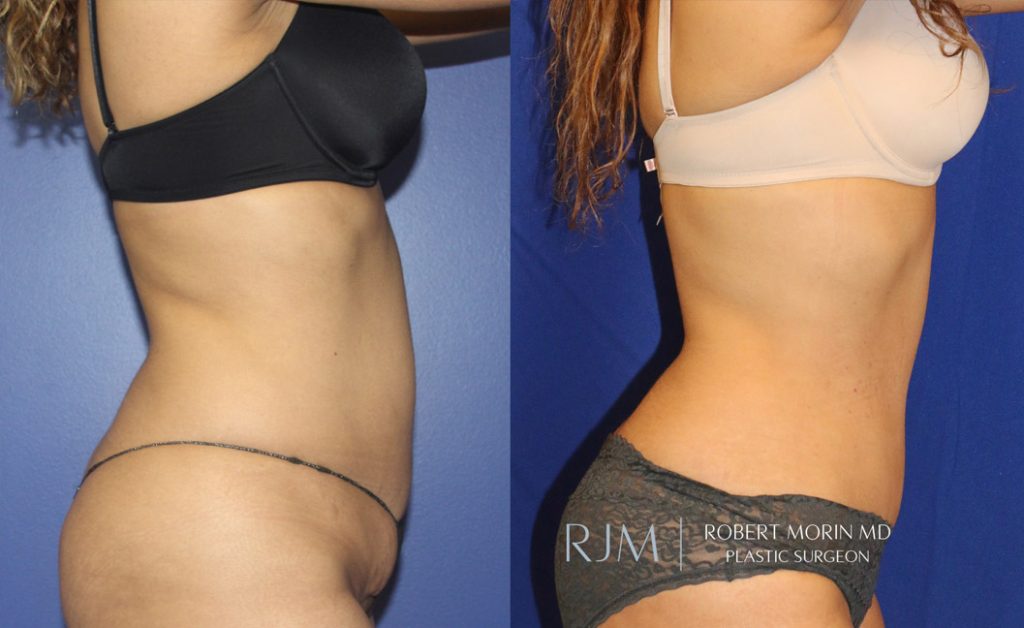  Woman's body, before and after abdominoplasty treatment in New Jersey, r-side view, patient 3