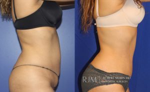  Woman's body, before and after abdominoplasty treatment, r-side view, patient 3