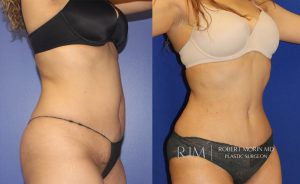  Woman's body, before and after abdominoplasty treatment, oblique view, patient 3
