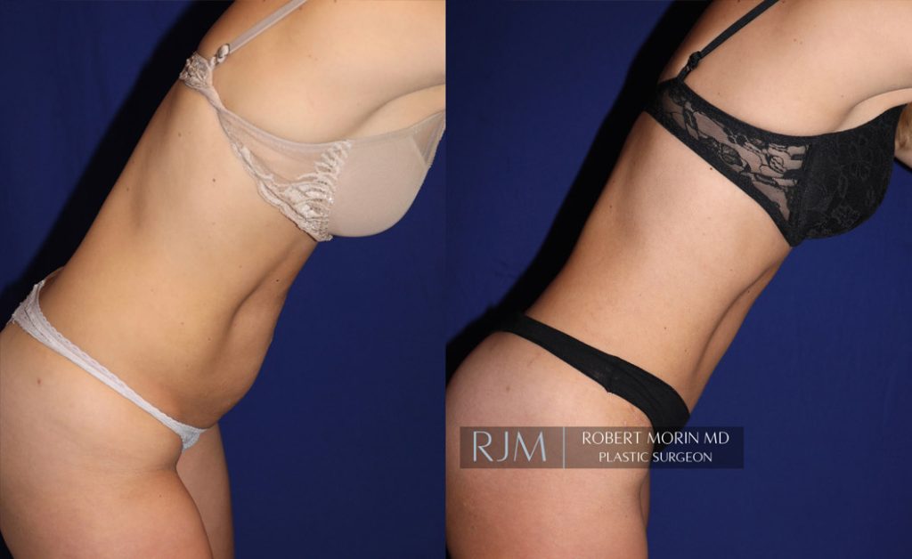  Woman's body, before and after abdominoplasty treatment in New Jersey, r-side view (bend over), patient 4