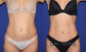  Woman's body, before and after abdominoplasty treatment in New Jersey, front view, patient 4