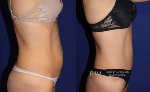  Woman's body, before and after abdominoplasty treatment, r-side view, patient 4
