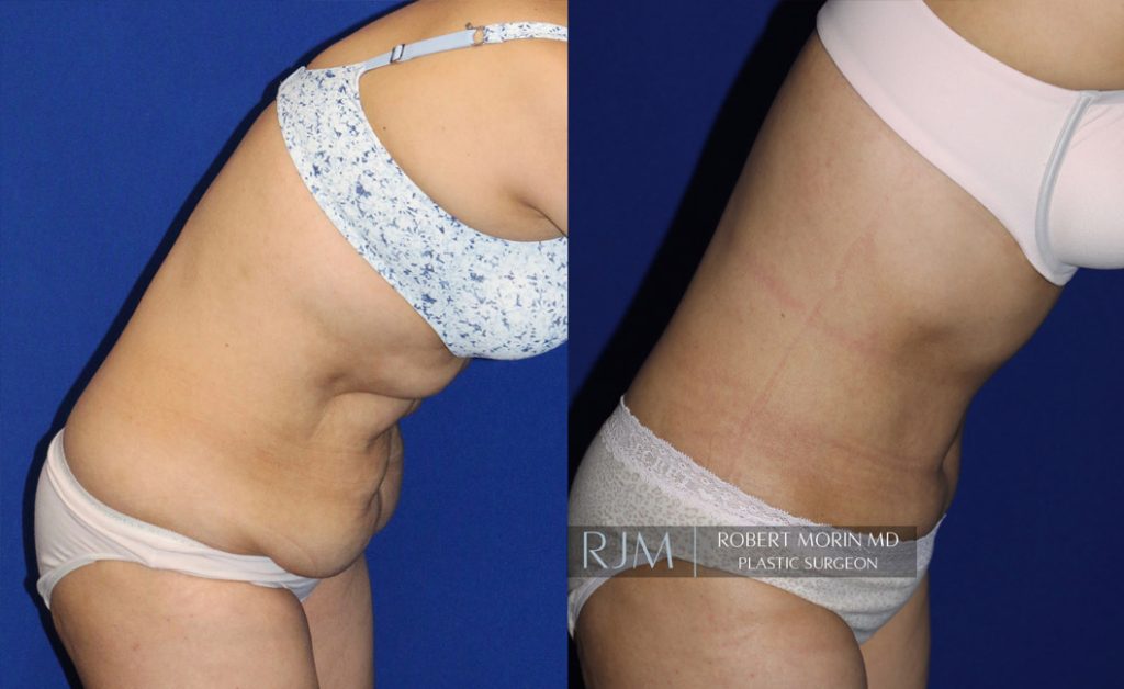  Woman's body, before and after abdominoplasty treatment in New Jersey, r-side view (bend over), patient 6