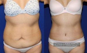 Woman's body, before and after abdominoplasty treatment, front view, patient 6