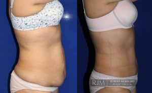  Woman's body, before and after abdominoplasty treatment, r-side view, patient 6