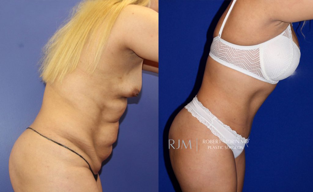  Woman's body, before and after abdominoplasty treatment in New Jersey, r-side view (bend over), patient 7
