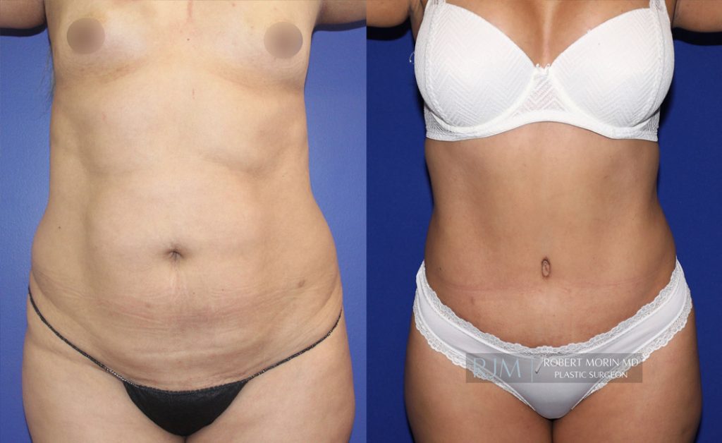  Woman's body, before and after abdominoplasty treatment in New Jersey, front view, patient 7