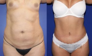  Woman's body, before and after abdominoplasty treatment, front view, patient 7