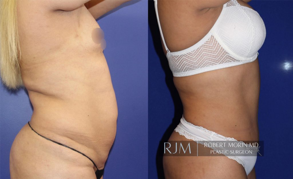  Woman's body, before and after abdominoplasty treatment in New Jersey, r-side view, patient 7