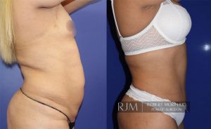  Woman's body, before and after abdominoplasty treatment, r-side view, patient 7