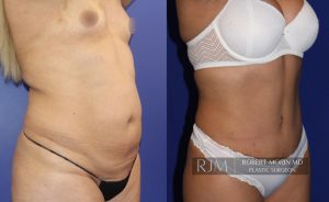  Woman's body, before and after abdominoplasty treatment, oblique view, patient 7