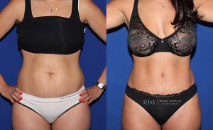  Woman's body, before and after abdominoplasty treatment, front view, patient 1