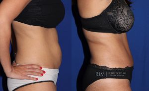  Woman's body, before and after abdominoplasty treatment in New Jersey, r-side view, patient 1