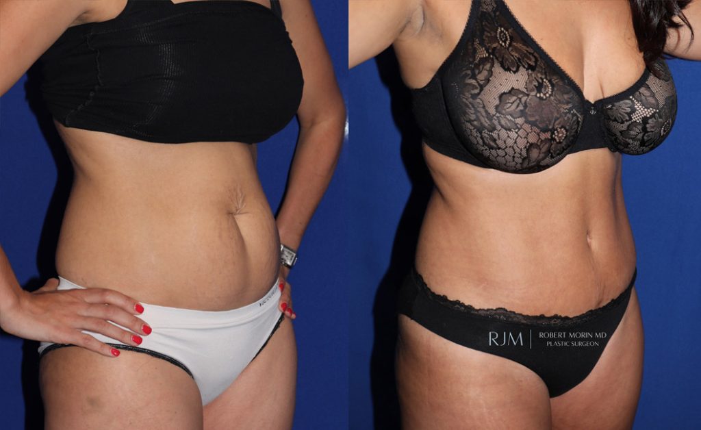  Woman's body, before and after abdominoplasty treatment in New Jersey, oblique view, patient 1