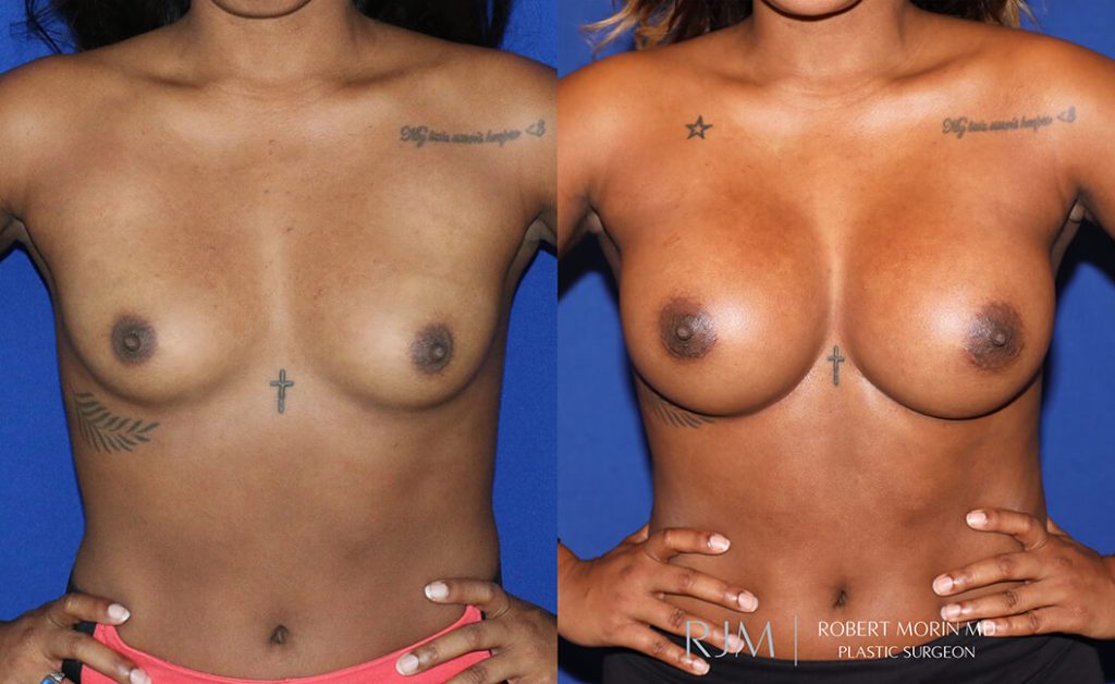  Woman's body, before and after Breast Augmentation treatment in New Jersey, front view, patient 13