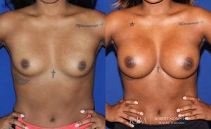  Woman's body, before and after Breast Augmentation treatment, front view, patient 10