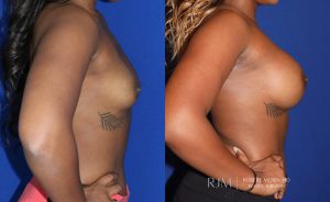  Woman's body, before and after Breast Augmentation treatment in New Jersey, r-side view, patient 13