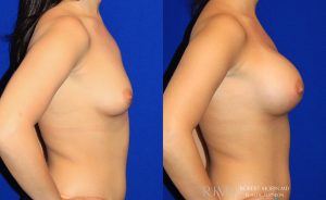  Woman's body, before and after Breast Augmentation treatment, r-side view, patient 14