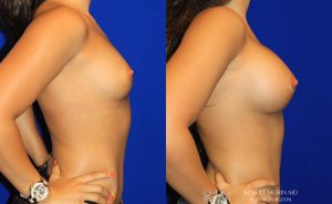  Woman's body, before and after Breast Augmentation treatment, r-side view, patient 11