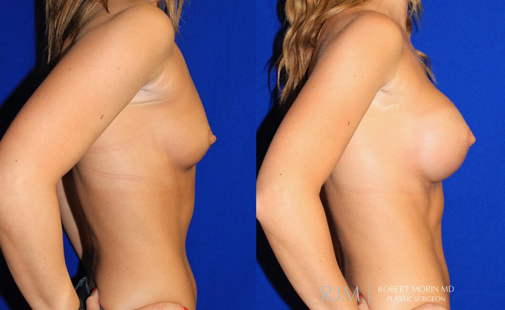 Woman's body, before and after Breast Augmentation treatment in New Jersey, r-side view, patient 10
