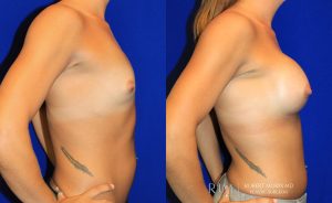  Woman's body, before and after Breast Augmentation treatment, r-side view, patient 15