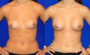  Woman's body, before and after Breast Augmentation treatment, front view, patient 16
